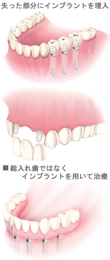 失った部分にインプラントを埋入　総入れ歯ではなくインプラントを用いて治療